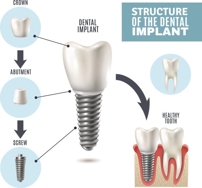 Structure of the dental implant infographic