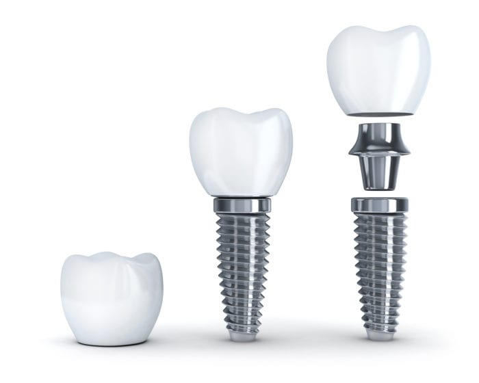 Replacing missing teeth with dental implants washington dc