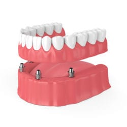 implants dental washington dc dentures vs