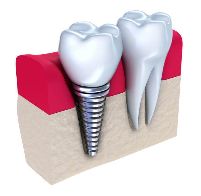 dental implant washington d.c.