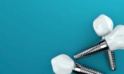 dental implants help jawbone health in Washington DC