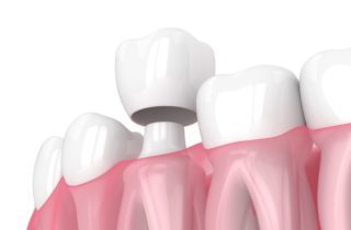dental crown advantages Washington DC